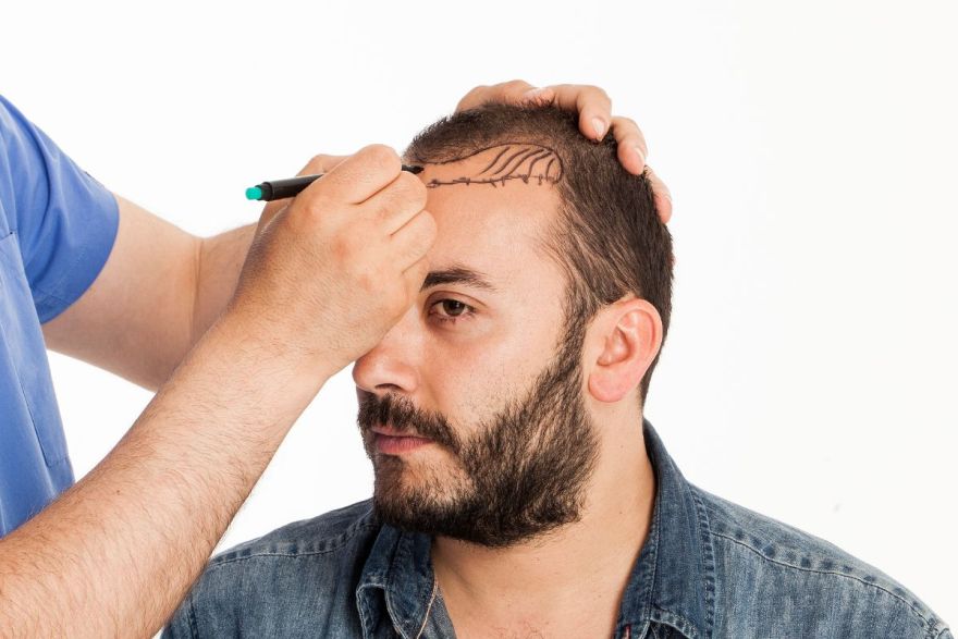 trapianto dei capelli